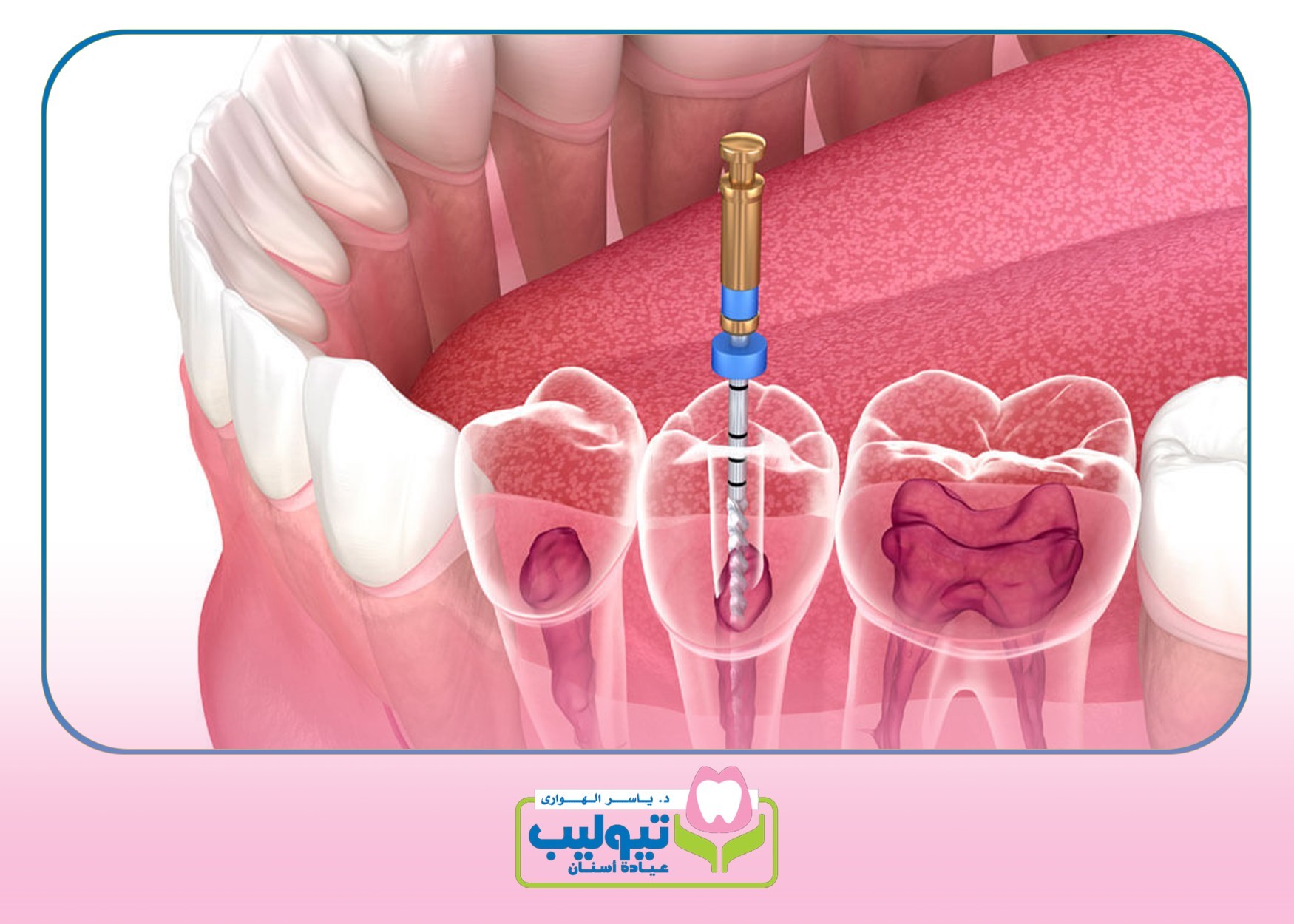 تعديل الأسنان بالتقويم image