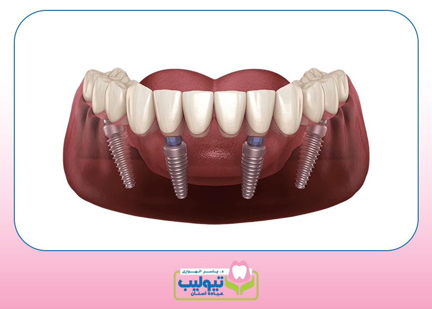Jawbone grafting image